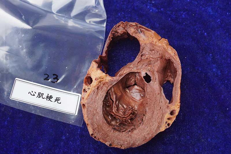 人体病理标本