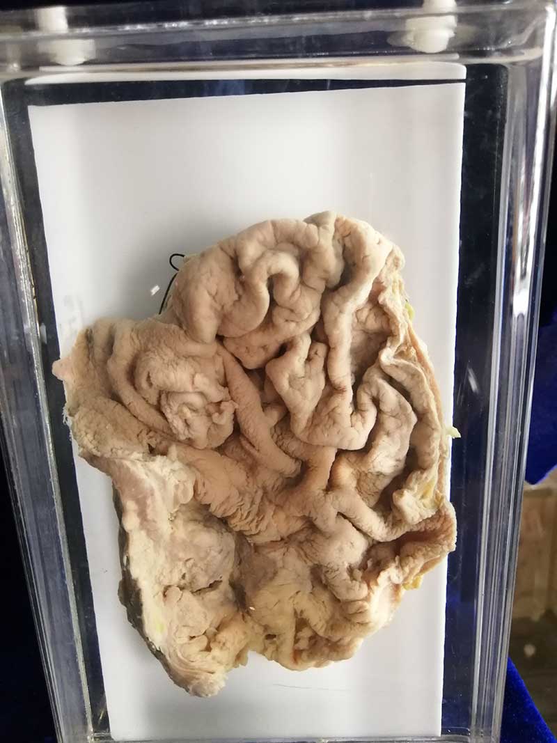 人体病理标本